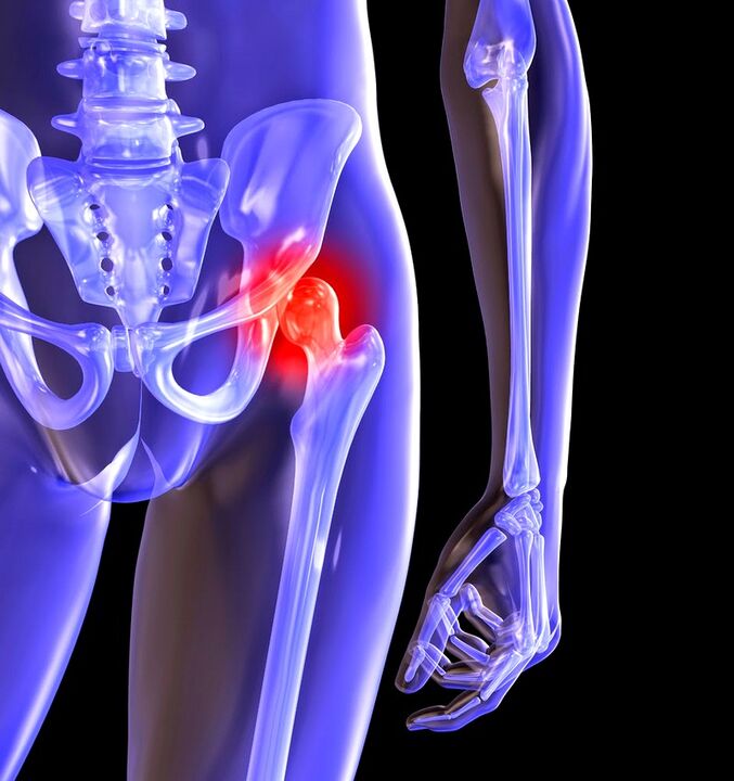 Déforme l'arthrose de l'articulation de la hanche