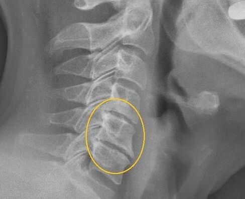 Ostéochondrose de la colonne cervicale sur un rayon x