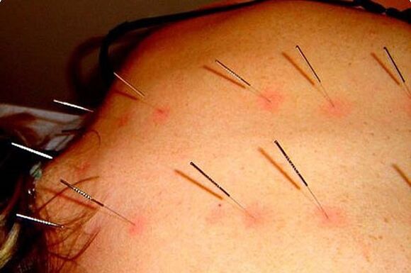 L'acupuncture, une méthode pour traiter l'ostéochondrose cervicale